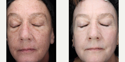 Woman treated with Scar Removal, Laser Scar Removal - Woman treated with Laser Resurfacing