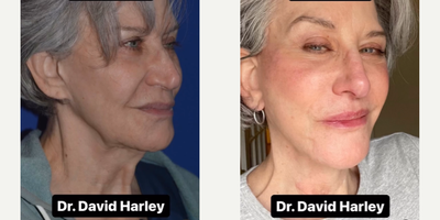 Woman treated with Facelift, Neck Lift - Deep plane facelift surgery provides the best and most natural improvements available for addressing midface, lower face, and neck aging.This patient desired improvement in the nasolabial folds, the midface, the jawline, the jowls, and the neck. With deep plane facelifting performed under local anesthesia, we were able to create a more heart-shaped face, improve jawline definition, and tighten up the neck.We addressed the nasolabial folds and the marionette lines and gave her a smoother appearance overall.We are extremely pleased with the outcome, and so is this lovely patient! We are grateful to her for allowing us to demonstrate her beautiful facelift and neck lift results!