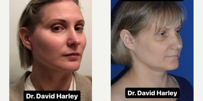 Woman treated with Facelift - What areas of the face are improved with an extended deep plane facelift and neck lift?Our patients come to us from all types of backgrounds and cultures, and each person has her own concerns she would like addressed.Among these include concerns regarding the nasolabial fold, marionette lines, jowls, loss of jawline definition, platysmal banding or cording, and skin loosening throughout the face and neck.Since adopting the extended deep plane facelift and neck lift procedure, Dr. David Harley, who is a double board-certified facial plastic surgeon specializing in facial rejuvenation, has helped his patients to achieve more improvement in the nasolabial fold and the midface curvature (the ogee curve) than has been traditionally possible.These procedures are performed daily in the office setting under local anesthesia. We perform strictly facelift, necklift, blepharoplasty, brow lift, lip lift, and other ancillary procedures.Patients travel throughout the country to visit us at one of our two locations, either at Isle of Palms, SC, or Cashiers, NC.We are sincerely thankful to this patient and the many others who have generously offered to share their photos!