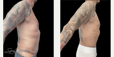 55-64 year old man treated with Abdominal Etching, Liposuction, Lymphatic Massage, Renuvion, Scar Removal, Skin Tightening, Vase - 55 year old gentleman who underwent VASER assisted liposculpting and Renuvion J plasma skin tightening of the abdomen, flanks, chest, axilla, lower back; chest masculinization procedure with fat grafting to the chest.