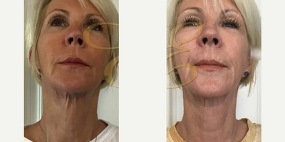 Woman treated with Skin Tightening - Woman treated with Skin Tightening