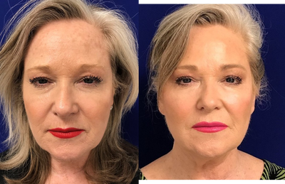 55-64 year old woman treated with Restylane Lyft - 60 year old Patient treated with Restylane Lyft in her cheeks and Botox in the forehead, glabella, bunny lines and crows feet.