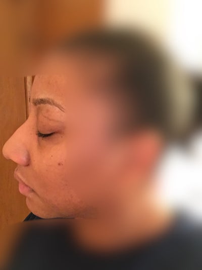 28 Year Old African American Woman Nose Job - Bedminster, NJ 