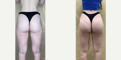 Woman treated with Butt Implants - Woman treated with Butt Implants