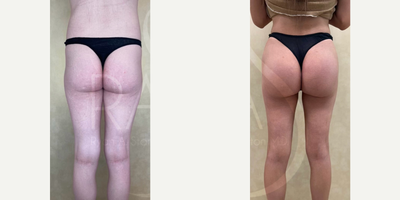 Woman treated with Butt Implants - Woman treated with Butt Implants