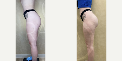 Woman treated with Butt Implants - Woman treated with Butt Implants