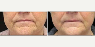Woman treated with Secret RF - Woman treated with Secret RF.
