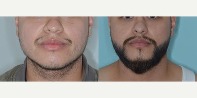 25-34 year old man treated with FUE Hair Transplant, Beard Transplant - 1 year post 2,000 FUE to beard.