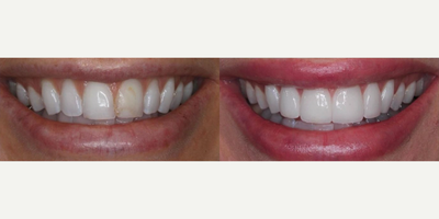 Woman treated with Smile Makeover, Teeth Whitening, Tooth Repair, Porcelain Veneers - This patient had an old bonding from an accident that constantly chipped and discolored through the years. We brought harmony to her smile using just 4 conservative feldspathic veneers, keeping the aesthetics close to her original teeth. Her treatment included minor gum recontouring, a whitening, and a correction of her midline.
