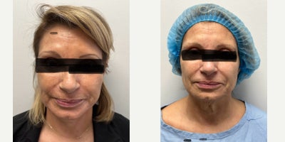 65-74 year old woman treated with MACS Facelift - 65-year-old female before and 2 months after MACS Minifacelift.
