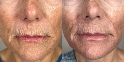 67 year old woman treated with Ellacor - A 67-year-old female underwent two Ellacor treatments targeting the perioral area to reduce wrinkles and improve skin texture. Over the course of the treatment, her skin displayed significant smoothness and tightening, achieving a more rejuvenated and youthful appearance while maintaining a natural look. Results reflect precise and effective skin revitalization.