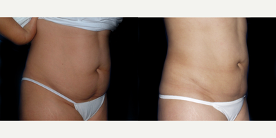 25-34 year old woman treated with Liposuction - Female Liposuction - Abdomen and Flanks