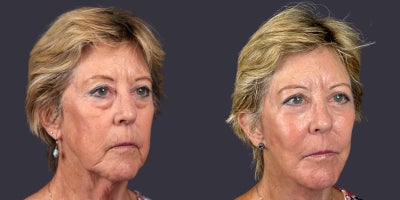 65-74 year old woman treated with Facelift, Eyelid Surgery, CO2 Laser, Skin Rejuvenation, Lower Facelift, Neck Lift, SMAS Faceli - This 68 year old woman is 5'2 and 129 pounds. She presented requesting facial rejuvenation. She had a deep plane - SMAS facelift and neck lift, lower eyelid blepharoplasty, corner of the mouth lift, and central face skin rejuvenation with CO2 laser resurfacing.