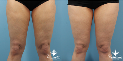 35-44 year old woman treated with Emtone - Improved skin laxity in knees and appearance of cellulite after 4 treatments of Emtone