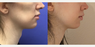 Patient treated with Adam's Apple Reduction and Chin Reduction and Contour - 25 t0 34 year-old female patient is 1 year post-op from Facial Feminization surgery. Her procedures included: Forehead Lift, Hairline Lowering, Supra Orbital Bone Reduction and Contour, Septorhinoplasty (closed) with Cartilage Grafts and Weirs, Chin Reduction and Contour, Soft Tissue to Nasolabial Folds, and Thyroid Cartilage Shave.