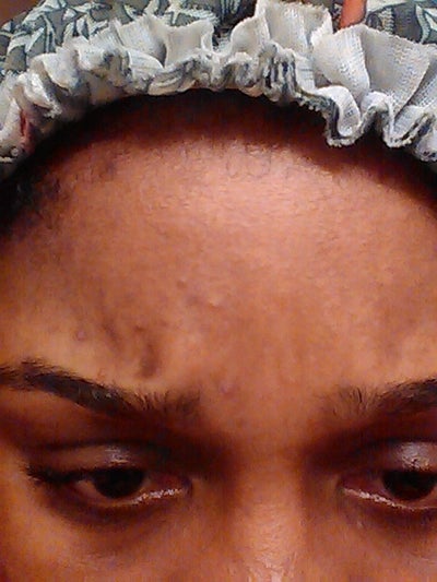 How to get rid of dark spots fast? (photos) Doctor Answers 