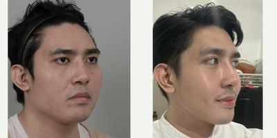 25-34 year old man treated with Cheekbone Reduction, V Line Surgery - .