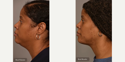 Woman treated with Mini Neck Lift - Woman treated with Mini Neck Lift