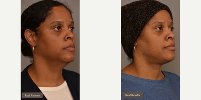 Woman treated with Mini Neck Lift - Woman treated with Mini Neck Lift