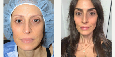 25-34 year old woman treated with Eyebrow Transplant - Before and one year after an eyebrow transplant