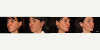 55-64 year old woman treated with Non-Surgical Neck Lift - Treated with FaceTite RF
