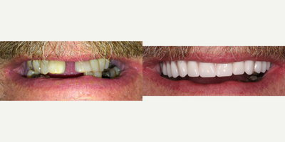 55-64 year old man treated with upper locator implant denture - Patient had non-salvageable upper teeth, corrected with implant retained denture to restore aesthetic and function. Post operative time: 4 months