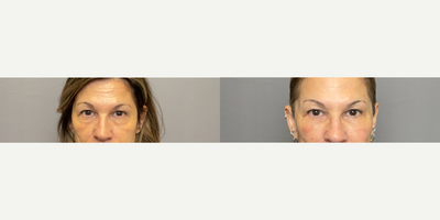 45-54 year old woman treated with Dermal Fillers, Restylane Lyft, Restylane - Under eye filler