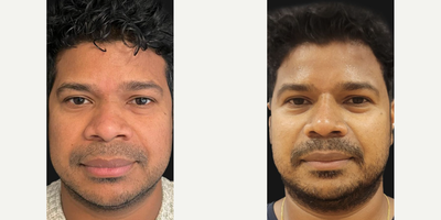 Man treated with African American Rhinoplasty, Rhinoplasty - No osteotomies or wide dissections were needed to achieve this perfectly balanced result. Just subtle touches and a diced cartilage with fascia to beautifully augment the nose through closed rhinoplasty.Its as if this nose was always meant to be.