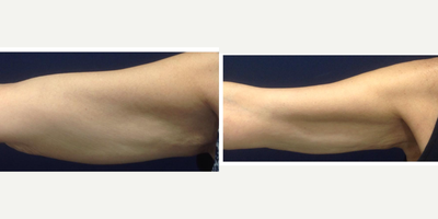 65-74 year old woman treated with Exilis - Biostimulation with Radiesse for arms in adult women, complemented with exilis.