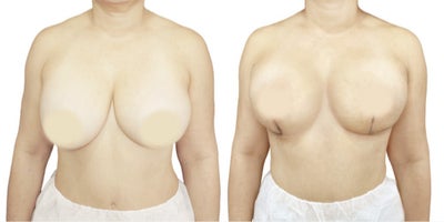 35-44 year old woman treated with Breast Implant Removal, Breast Reconstruction, Breast Lift - Breast implant removal is more than just removing the prosthesis and capsules. It's reconstructive surgery that has aesthetic goals for our patients. The great thing about this surgery is that we can use the patient's tissue for reconstruction, allowing immediate results. Plus, it's almost always painless and leaves an L-shaped scar with no scars in the cleavage area. Thanks to the BRALAN Technique(Breast Reconstruction Anatomical Lift Augmentation), we can achieve a consistent and stable aesthetic result regardless of breast tissue size.