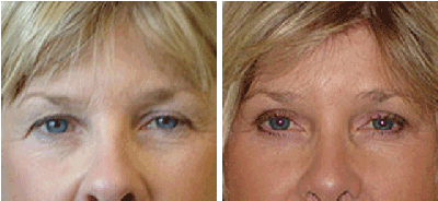 Eyelid Surgery and Browlift - 	Eyelid Surgery
