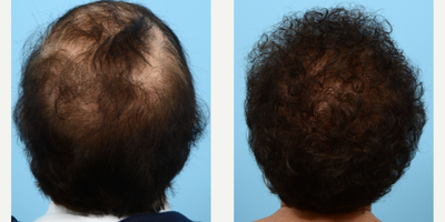 65-74 year old woman treated with Low-Level Laser Therapy - This 71-year-old patient was experiencing a lot of hair loss in addition to thinning on the sides and crown. To fill in these areas and add density overall, Dr. Wise performed an FUT hair transplant using 2,030 grafts, during which she also underwent one session of PRP.