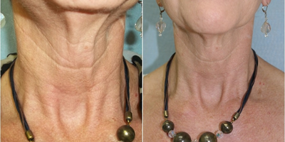 InMode Fractora to the neck of 56 year old woman - InMode Fractora to the neck of 56 year old woman; one month after treatment