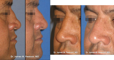 Revision Rhinoplasty / Nasal Surgery - 
	Revision Rhinoplasty / Nasal Surgery
