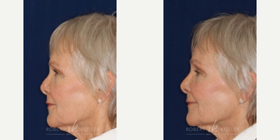 Permanent Non-surgical Revision Rhinoplasty - Restoration to the natural tip and concealment of hump leading to a nose that no longer appears over operated.