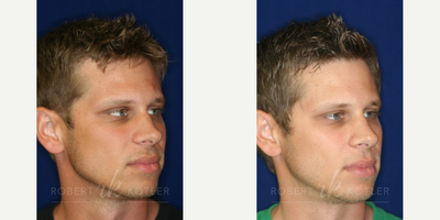 Permanent Non-surgical Rhinoplasty - Raising low bridge, improving tip structure and obscuring hump with Permanent Filler.