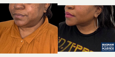 35-44 year old woman treated with Buccal Fat Removal, Chin Liposuction - 36 y.o female who was concerned with fullness in her buccal area and double chin chin appearance underwent Facial Slimming Surgery which combines buccal fat removal with chin and neck liposculpting. At 2 months post-op, sought a more well defined cheek secondary to buccal fat removal. Her double chin is gone and he jawline is significantly improved.