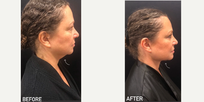 55-64 year old woman treated with Chin Liposuction, FaceTite - 56 y.o female who was concerned with double chin chin appearance, neck laxity and poorly defined jawline underwent chin and neck liposculpting and facetite under local anesthesia . At 2 months post-op, her double chin is gone and her jawline and neck laxity is significantly improved.