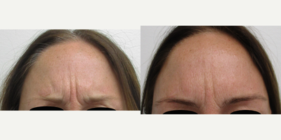 25-34 year old woman treated with Botox, Micro Botox - 29 year old model before and 1 week after BOTOX Cosmetic injection of her glabella. Notice the 50% reduction of her wrinkles while frowning. She was an actress and wanted to be able to express herself for her work so looking natural was important to her.