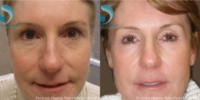 55-64 year old woman treated with Laser Treatment - Before and After Portrait Plasma Resurfacing