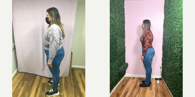 35-44 year old woman treated with Endoscopic Sleeve Gastroplasty - She lost 49 lbs in 11 months after her Endoscopic Sleeve Gastroplasty Procedure