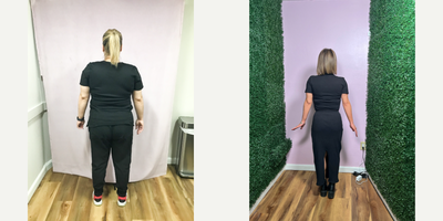 25-34 year old woman treated with Endoscopic Sleeve Gastroplasty - She lost 55 lbs with the Endoscopic Sleeve Gastroplasty procedure after 9 months
