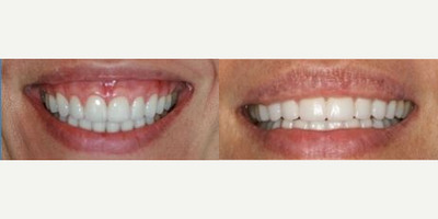 35-44 year old woman treated with Lip Lowering - This patient's gummy smile was treated with upper lip lowering so the upper lip appears to be more full.