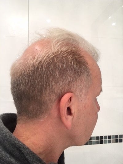 Very Good Experience To Get New Hairs Review Realself