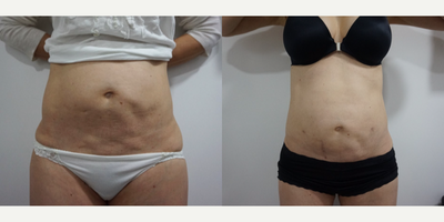45-54 year old woman treated Liposuction Revision - 45-54 year old woman treated Liposuction Revision
