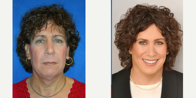 55-64 year old woman treated with Facial Feminization Surgery - Individual results may vary.