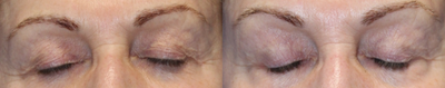 55-64 year old woman treated with Secret RF - The Secret RF treatment, 2 treatments scheduled 4 weeks apart.6 week followup.