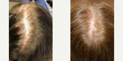 68 year old woman treated with PRP for Hair Loss, Exo-Xom, FUE Hair Transplant - 68 year old woman treated with PRP for Hair Loss, Exo-Xom, FUE Hair Transplant