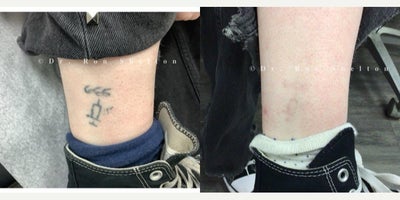 18-24 year old woman treated with PicoSure, Tattoo Removal - After 2 picoplus laser treatments on lower leg