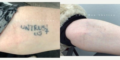 18-24 year old woman treated with PicoSure, Tattoo Removal - After 2 picoplus laser treatments on forearm
